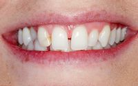 Edge Bonding - Smile 3 before